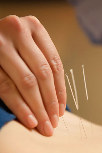 home_service_acupuncture1